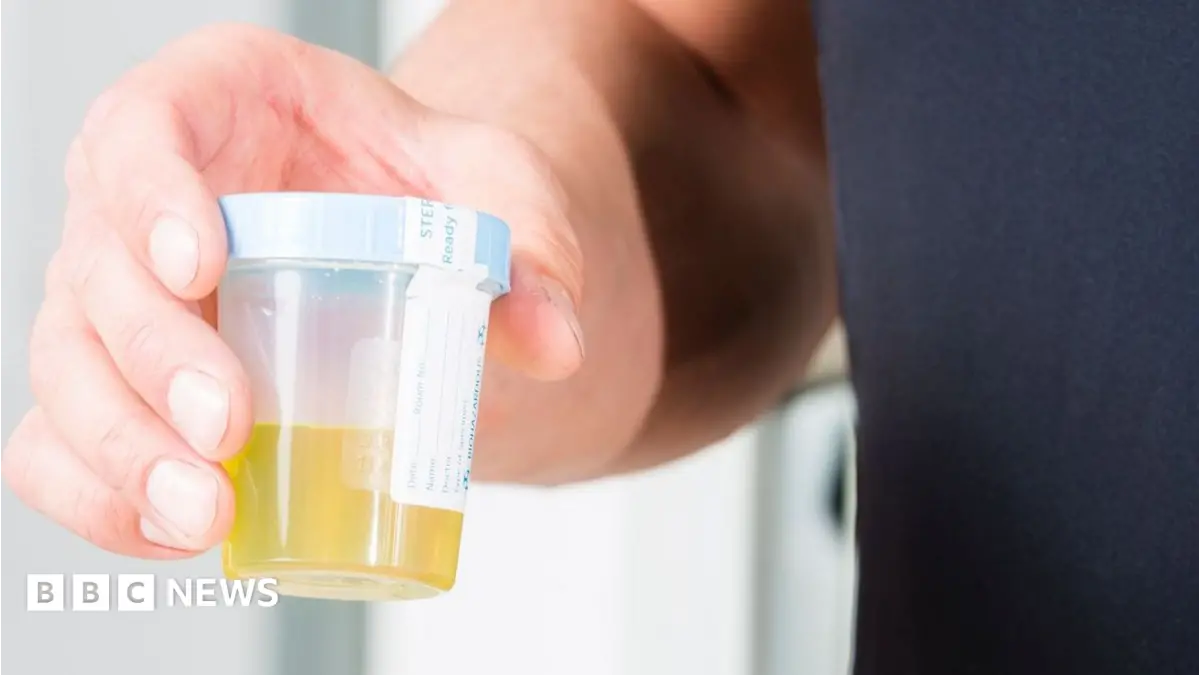 New Urine Test Identifies Over 90% of Bladder Cancers in NHS Trials