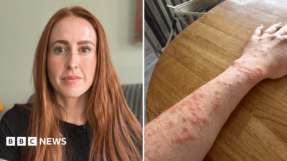 Travelodge Guest Suffers Bed Bug Attack at Euston Hotel, Seeks Redress