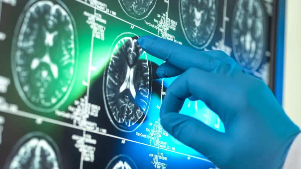 Breakthrough Alzheimer's Drugs 'Unlikely to Benefit Patients', Report Suggests Amidst Controversy